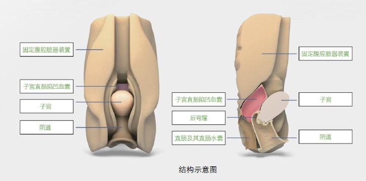 阴道后穹窿穿刺监测考核指导模型,模具 阴道后穹窿穿刺监测考核指导模型,模具